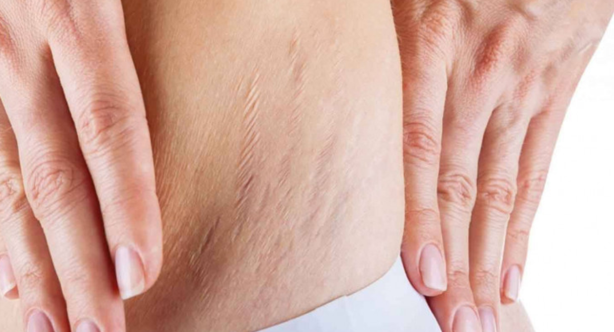 nevus