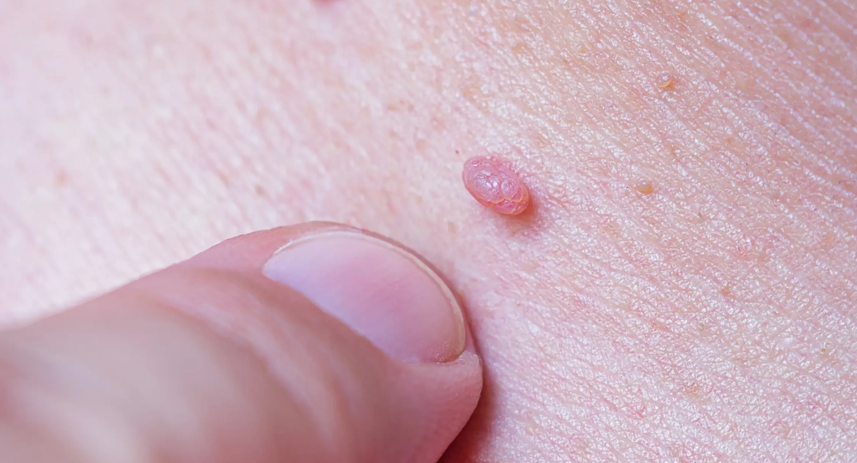 nevus