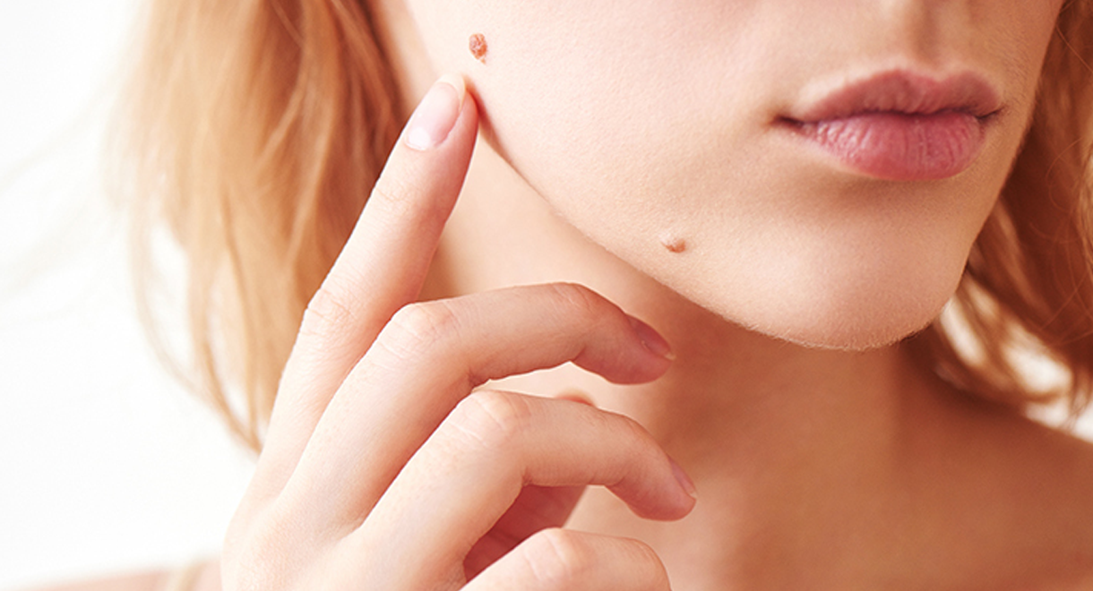 nevus